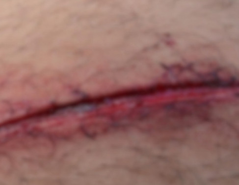 Lesão causada pela facada