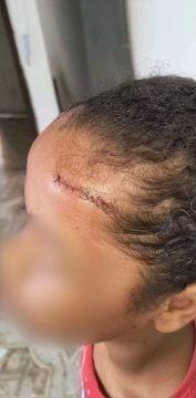 Crian&ccedil;a ferida ap&oacute;s acidente em balan&ccedil;o de pra&ccedil;a de Campos