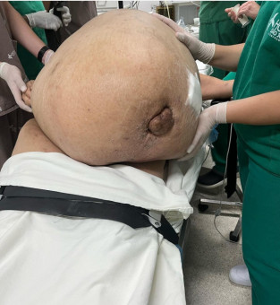 Remo��o de tumor gigante (Fotos: Reprodu��o Instagram)