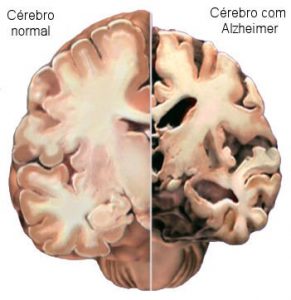 Alzheimer-cérebro